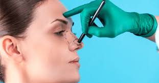 Rhinoplasty