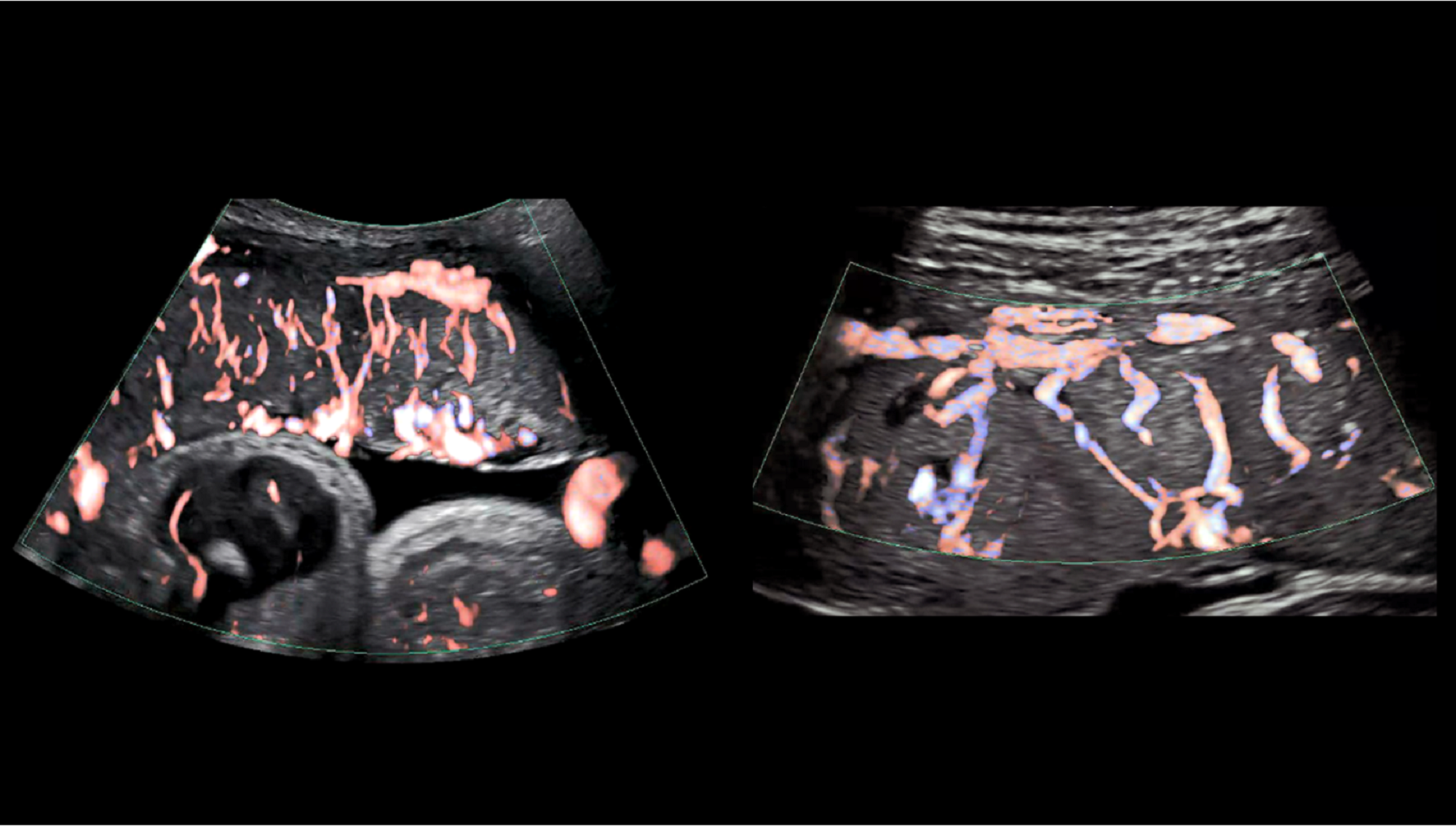 Two ultrasounds of fetal and maternal placental tissues