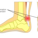 Achilles Tendon Injuries