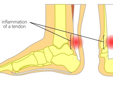 Achilles Tendon Injuries