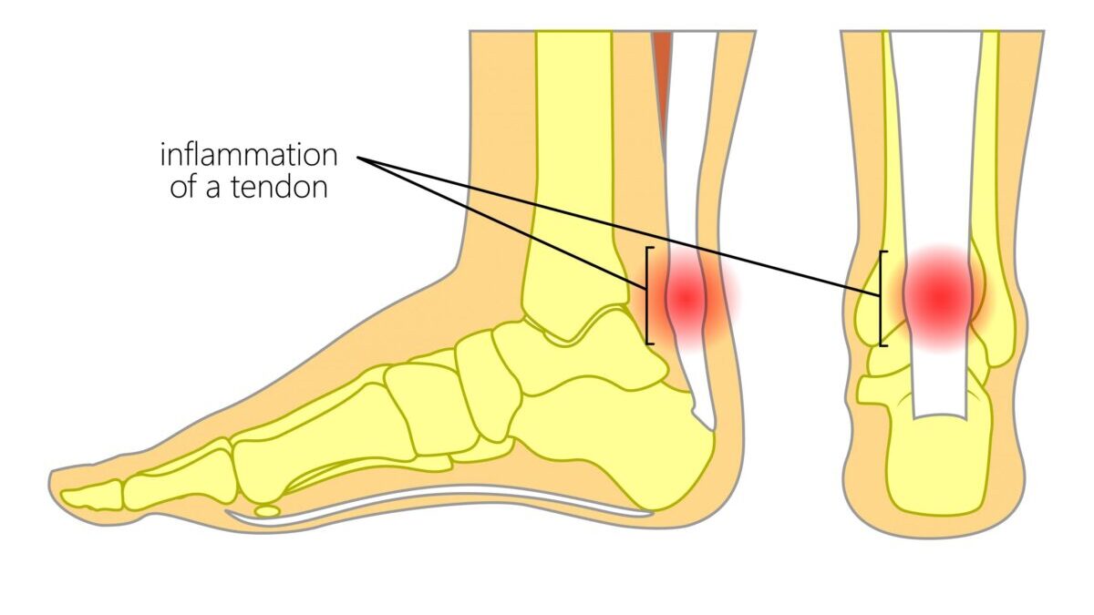 Achilles Tendon Injuries