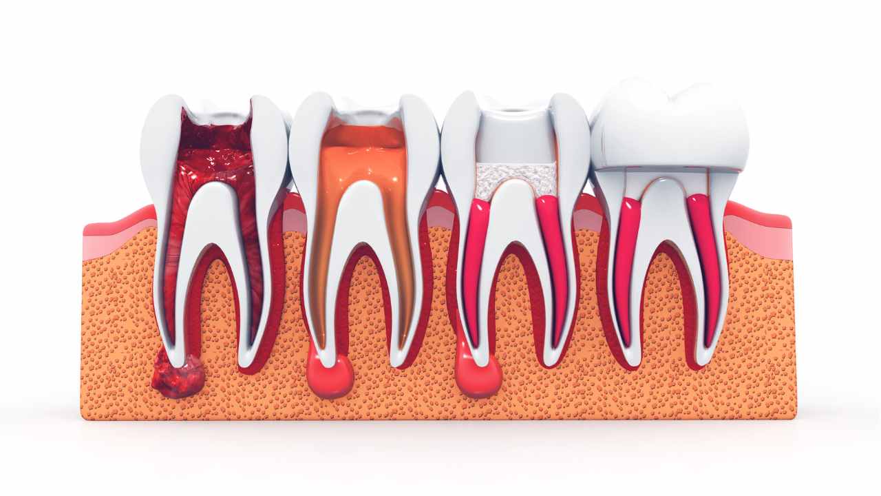 Expert Tips for a Painless Root Canal Experience