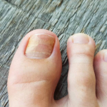 How to Heal a Toe Infection - Best Practices for Recovery