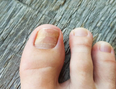 How to Heal a Toe Infection - Best Practices for Recovery