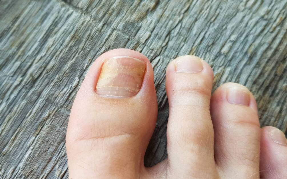 How to Heal a Toe Infection - Best Practices for Recovery