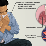 Tuberculosis In India: Understanding The Disease And The Road To Eradication