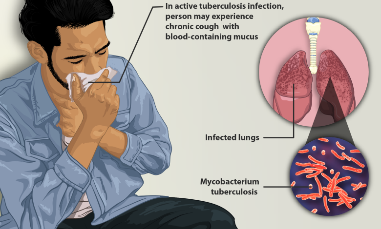 Tuberculosis In India: Understanding The Disease And The Road To Eradication