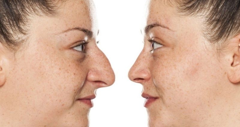 Nose surgery in Colombia
