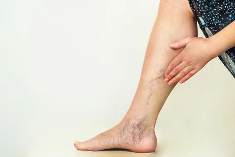 How Do Varicose Veins Benefit from Laser Treatment? Advice from the Vein Experts in Delhi