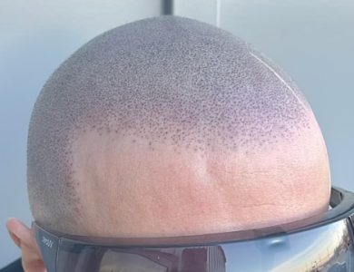 Scalp Micropigmentation: A Modern Solution to Hair Loss