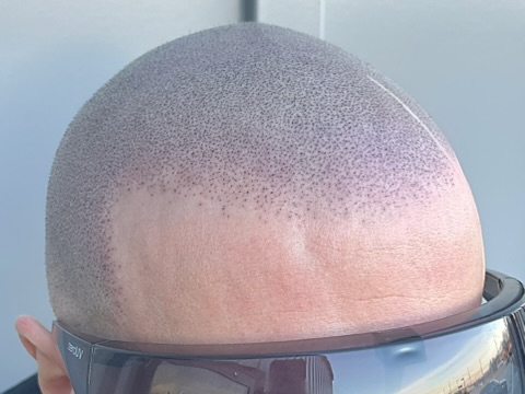 Scalp Micropigmentation: A Modern Solution to Hair Loss